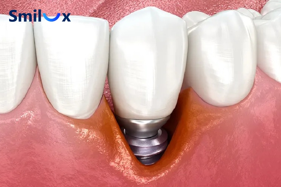 Bệnh tiểu đường làm tăng nguy cơ viêm trụ Implant