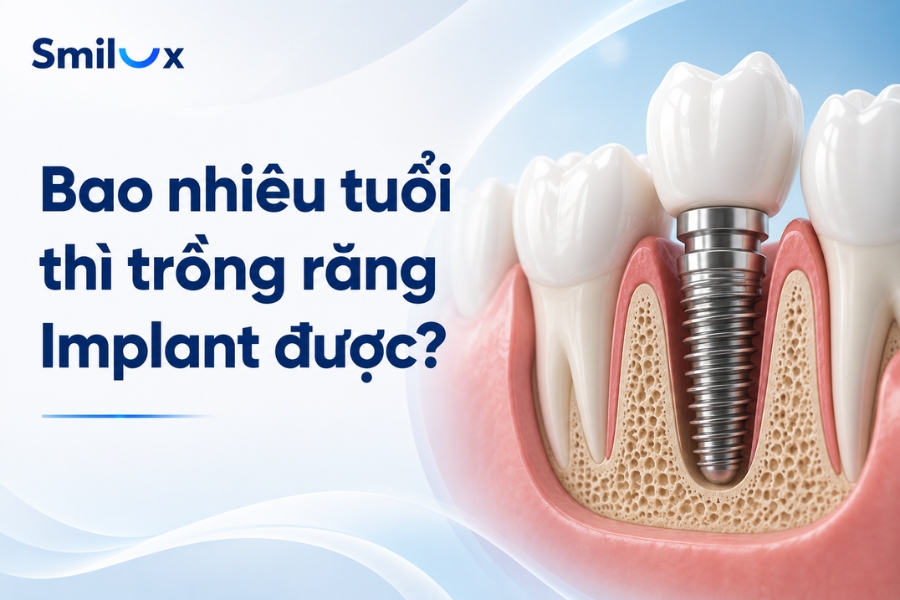 Bao nhiêu tuổi thì trồng răng Implant được? Bác sĩ giải đáp