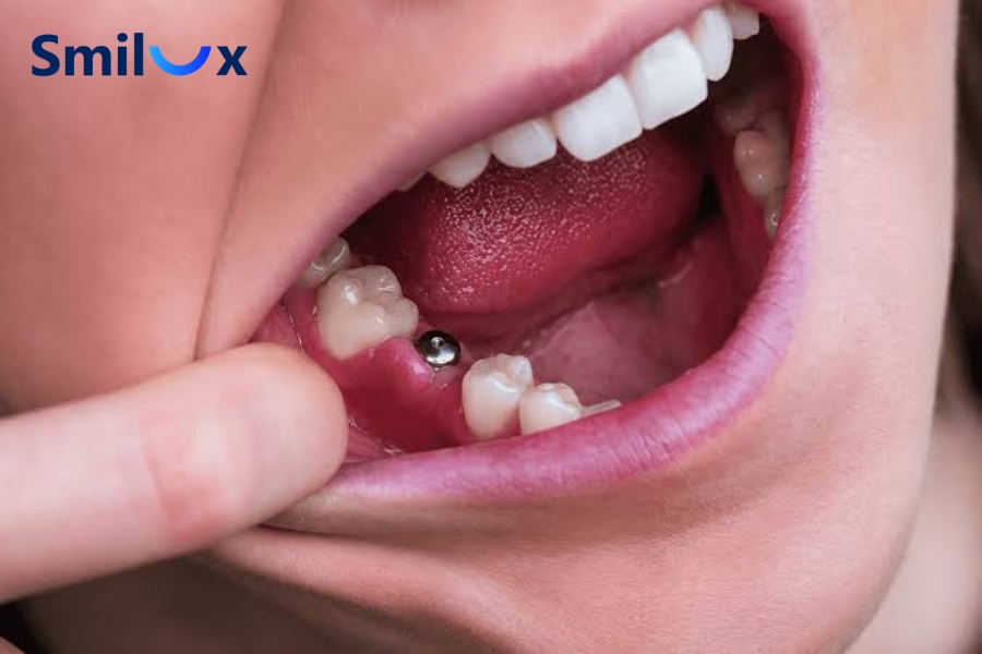 Các yếu tố ảnh hưởng đến thời gian cắm Implant sau nhổ răng