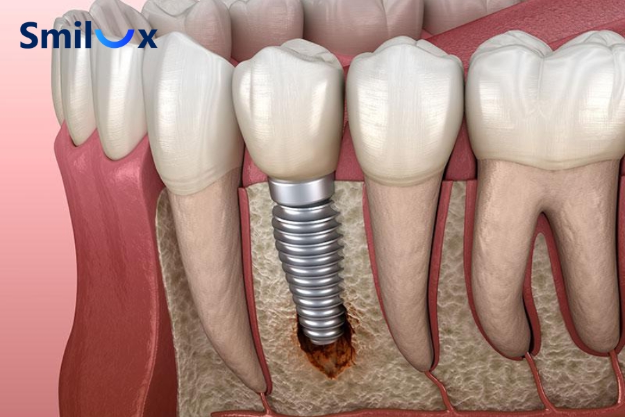 Bia rượu làm nhiễm trùng quanh trụ Implant