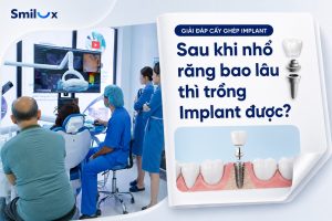 Sau khi nhổ răng bao lâu thì trồng Implant được? Bác sĩ Smilux giải đáp