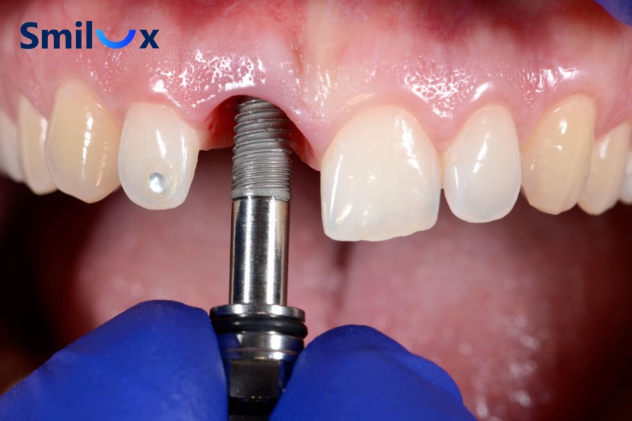Nhổ răng bao lâu thì trồng Implant được? Thời điểm phù hợp có thể là ngay lập tức, sau 4–8 tuần, 12–16 tuần hoặc trên 6 tháng