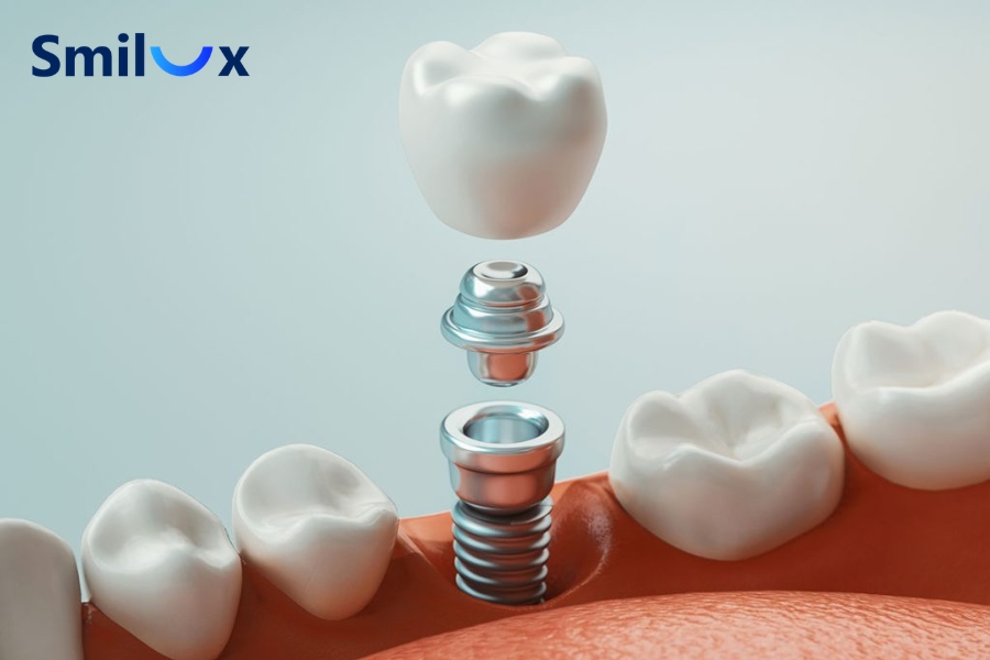 Cấy Implant khi xương hàm chưa phát triển hoàn chỉnh có thể khiến trụ lệch tương quan với răng thật và ảnh hưởng đến thẩm mỹ, khớp cắn về sau.