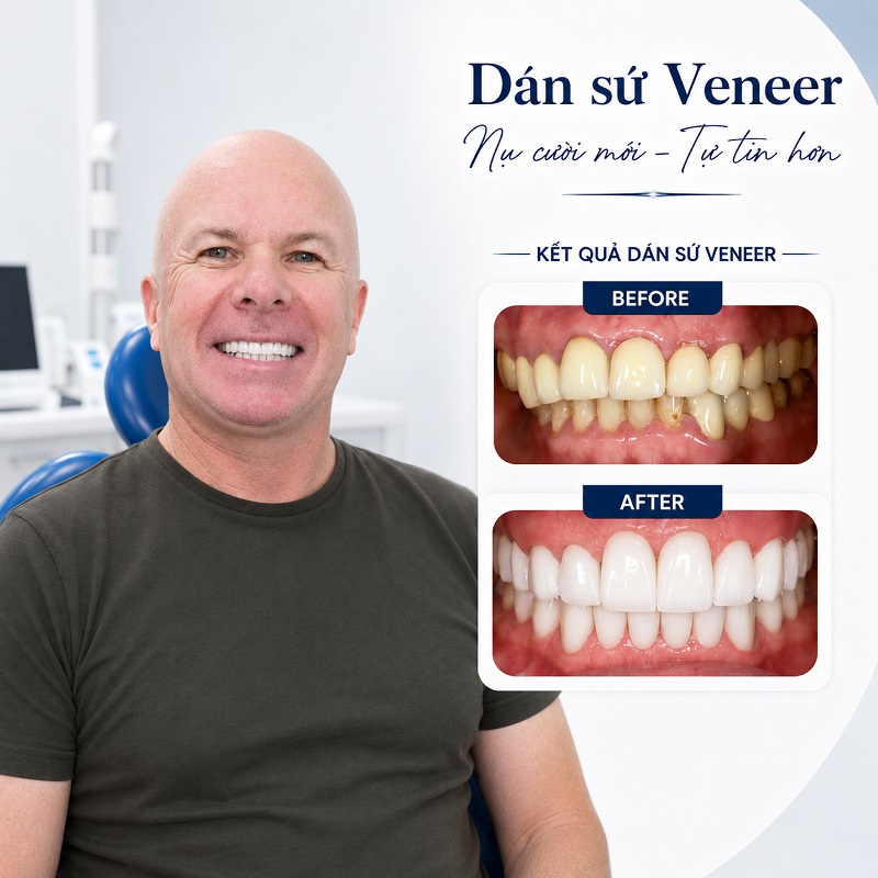 Hình ảnh thực tế khách hàng dán răng sứ
