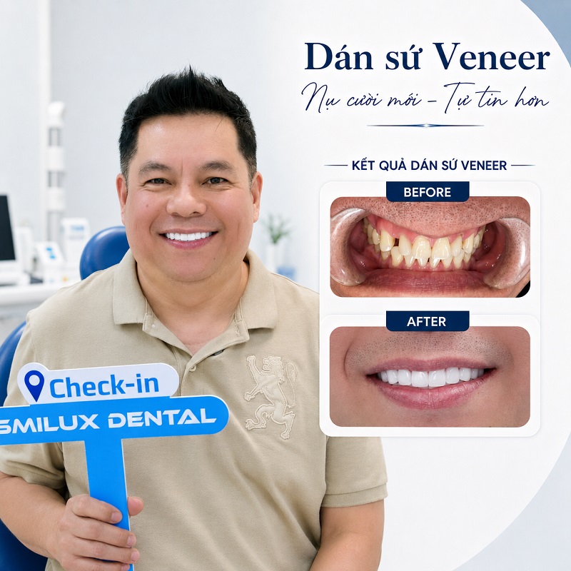 Hình ảnh thực tế khách hàng dán răng sứ