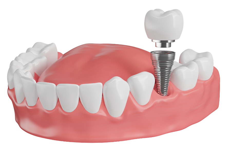 cay ghep implant tai