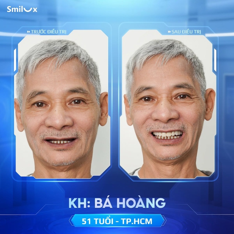 hình ảnh khách hàng implant
