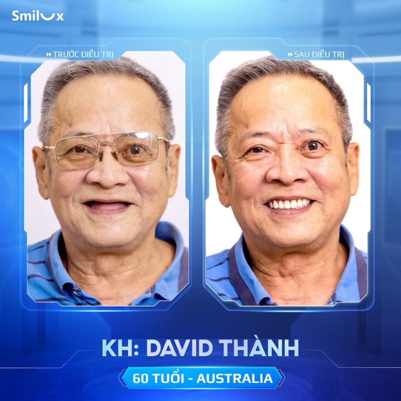 hình ảnh khách hàng implant