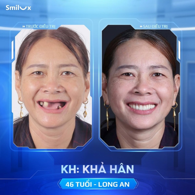 hình ảnh khách hàng implant
