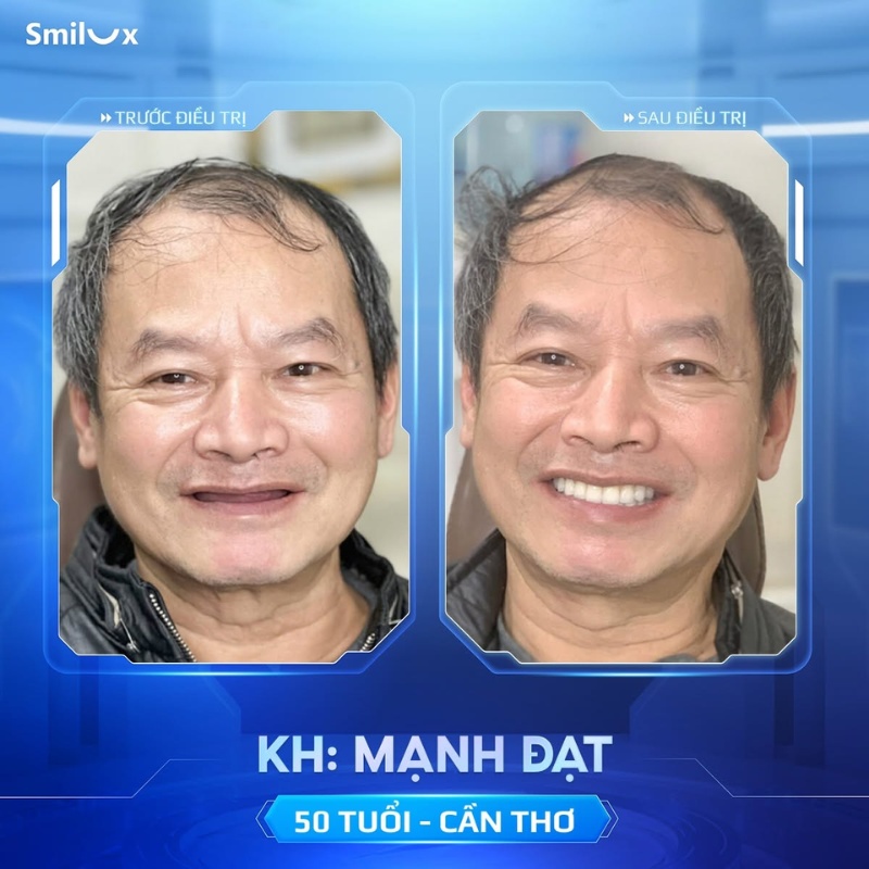 hình ảnh khách hàng implant
