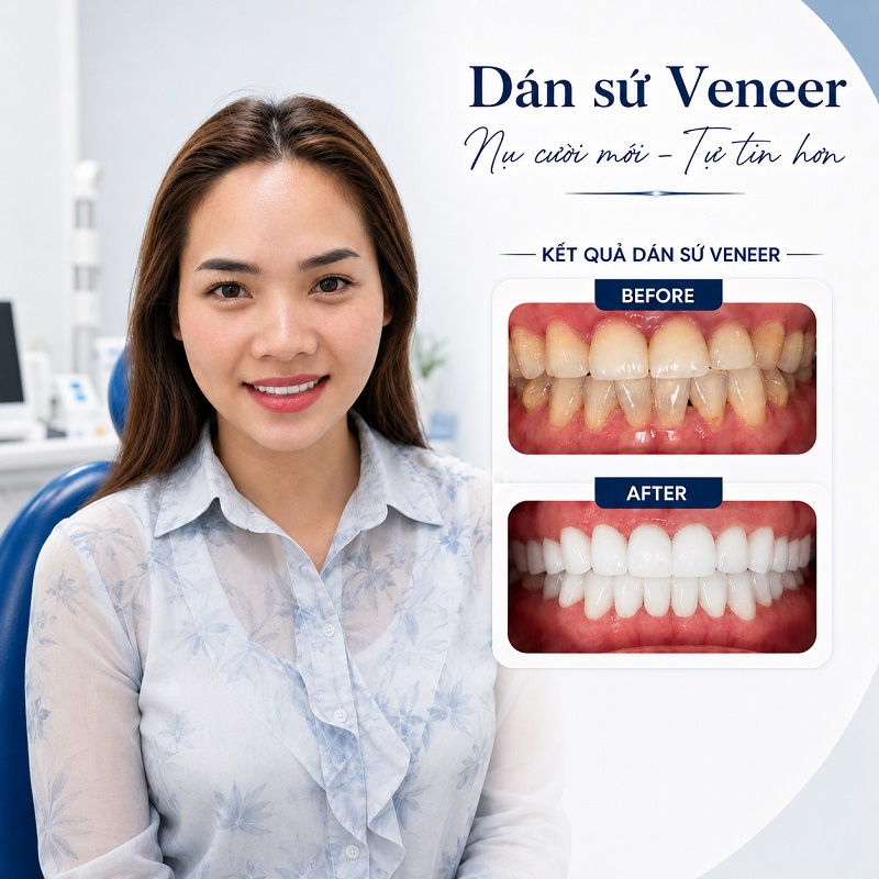 Hình ảnh thực tế khách hàng dán răng sứ