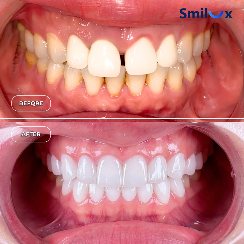 hình ảnh thực tế làm răng sứ