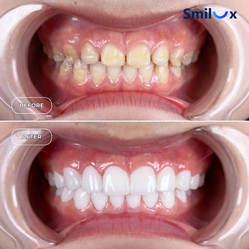 hình ảnh thực tế làm răng sứ