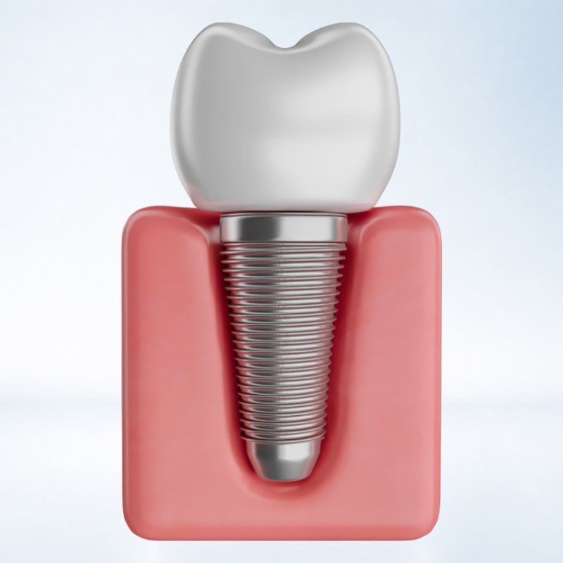 implant đơn lẻ