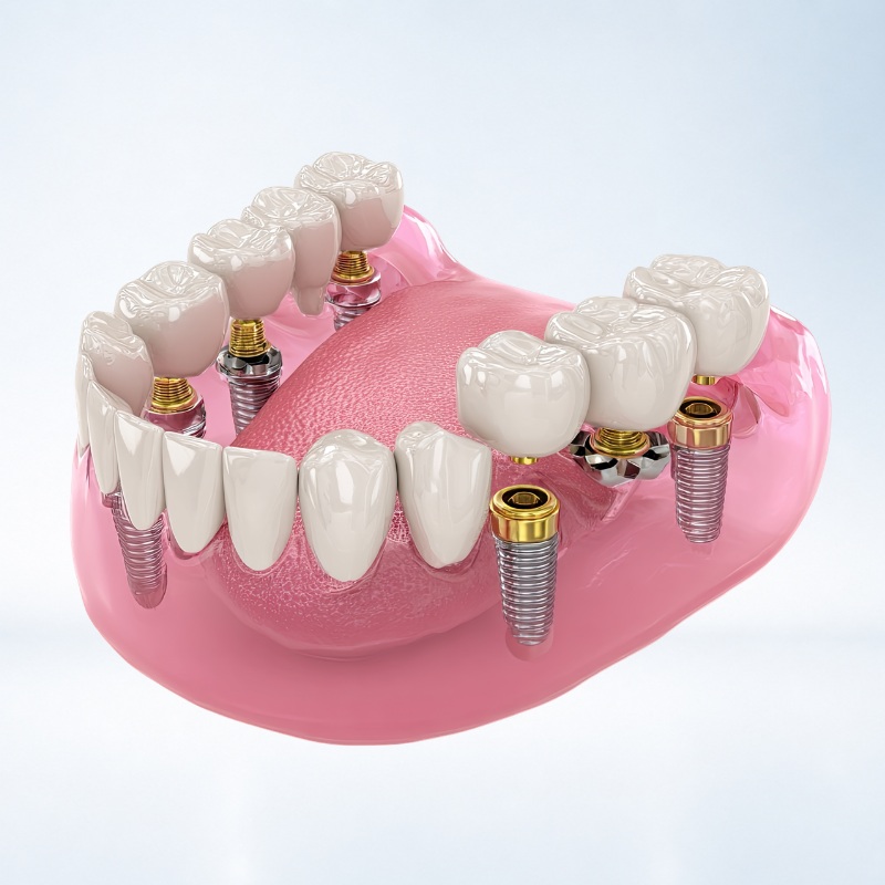 implant toàn hàm