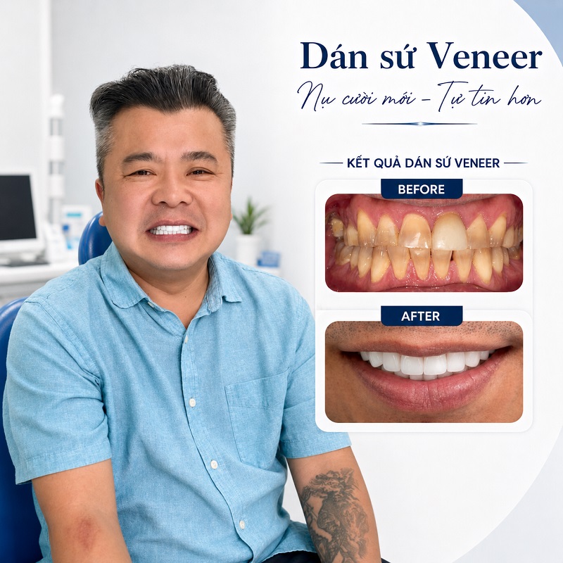 Hình ảnh thực tế khách hàng dán răng sứ