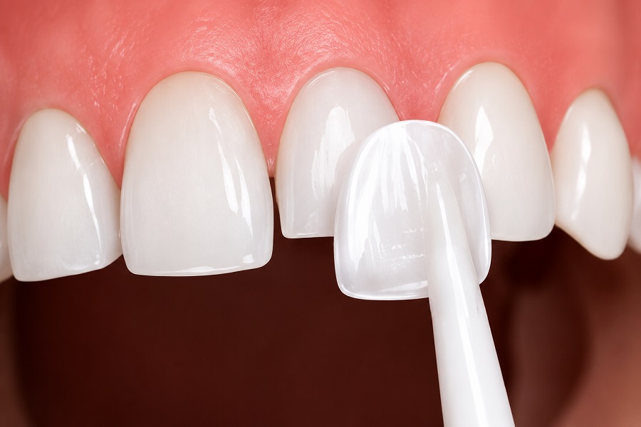 khái niệm dán sứ veneer