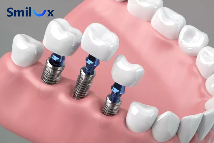 Một tháng có thể đủ để cấy 3 trụ Implant khi xương hàm tốt, sức khỏe ổn định và không cần ghép xương phức tạp.
