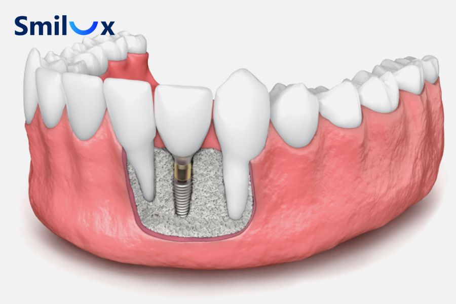 Vật liệu ghép xương khác nhau sẽ kéo theo mức chi phí điều trị khác nhau.