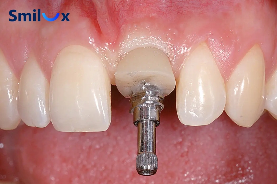Cấy ghép Implant tức thì cho phép đặt trụ ngay sau khi nhổ răng, giúp rút ngắn thời gian điều trị và giảm số lần phẫu thuật.