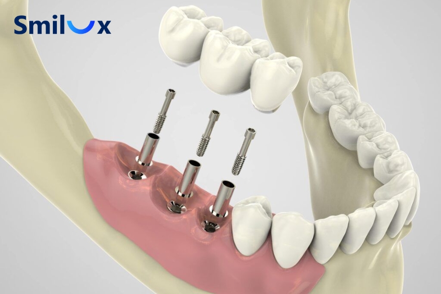 Khi nào có thể hoàn tất trồng 3 Implant trong 1 tháng?