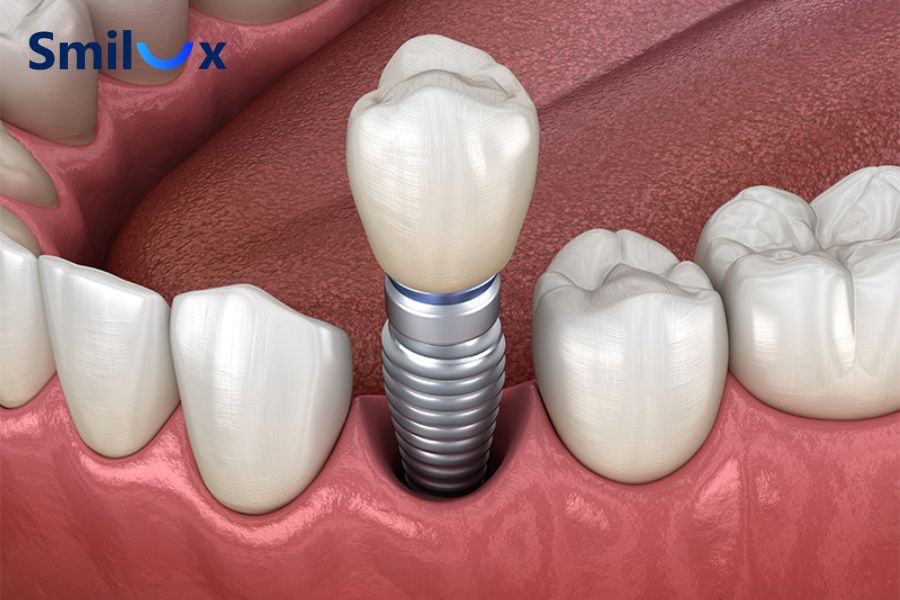 Cấy Implant trả góp giúp chia nhỏ chi phí điều trị, giảm áp lực tài chính