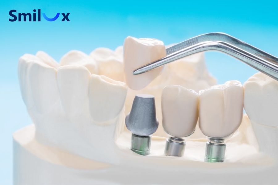 Implant có thể phục hình từ mất một răng, nhiều răng đến mất răng toàn hàm