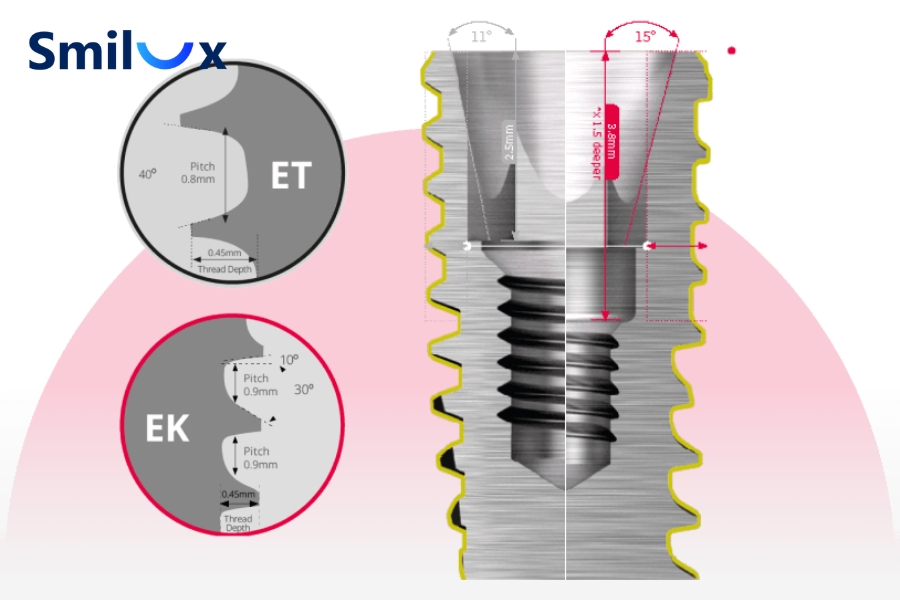 Thời điểm cấy ghép trụ Implant Hiossen