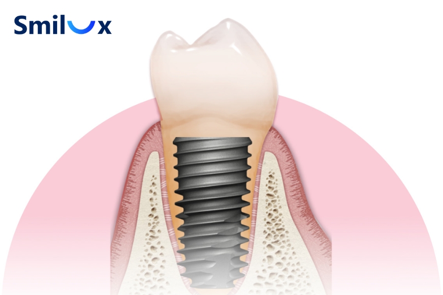 Trụ Implant Hiossen có xuất xứ từ Mỹ