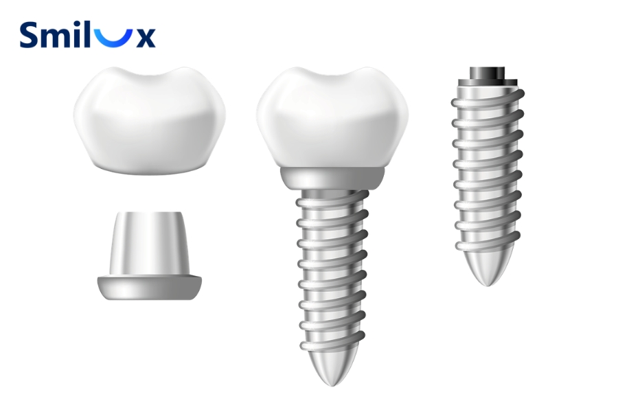 Trụ Implant Thụy Sĩ nổi bật với độ chính xác cao, độ bền tốt và khả năng tương thích sinh học