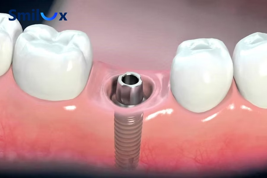 Ưu điểm cấy Implant tức thì