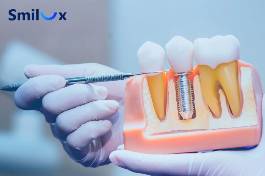 Ưu điểm của các dòng trụ Implant Đức