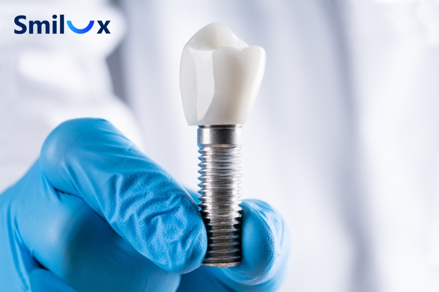 Implant Titanium có thể duy trì ổn định 20 – 25 năm
