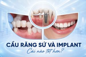 So sánh cầu răng sứ và Implant - Phương pháp nào tốt hơn?