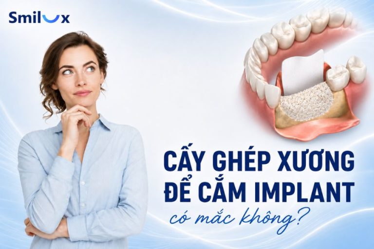 Cấy ghép xương để cắm Implant có mắc không? Bác sĩ Smilux giải đáp