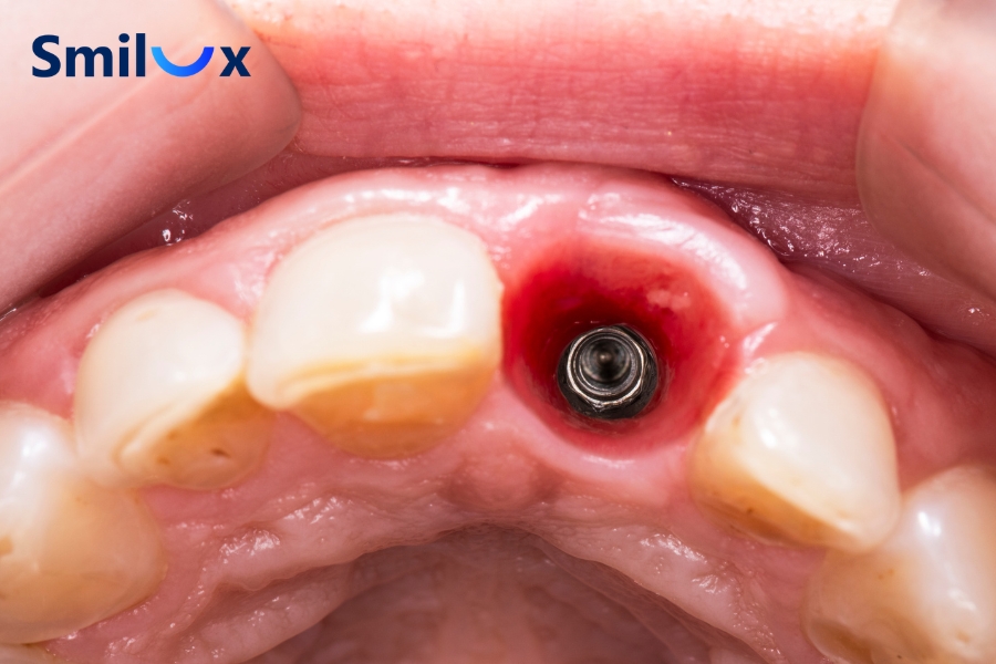 Uống nhiều cà phê có thể ảnh hưởng đến quá trình tích hợp xương, gây khô miệng