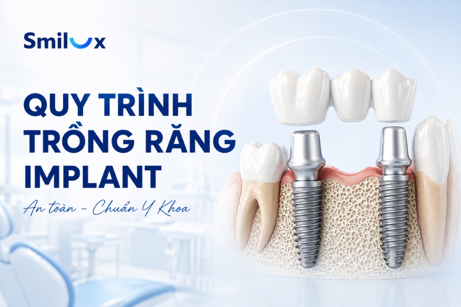 Quy trình trồng răng Implant chuẩn Y Khoa tại Smilux Dental