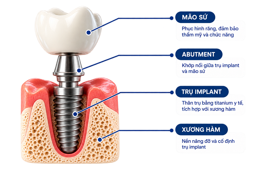 rang implant don le la gi