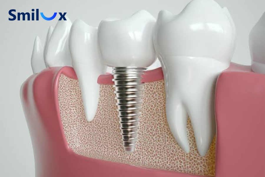 Công nghệ bề mặt SA và NH giúp tăng khả năng tiếp xúc với mô xương, hỗ trợ lành thương nhanh
