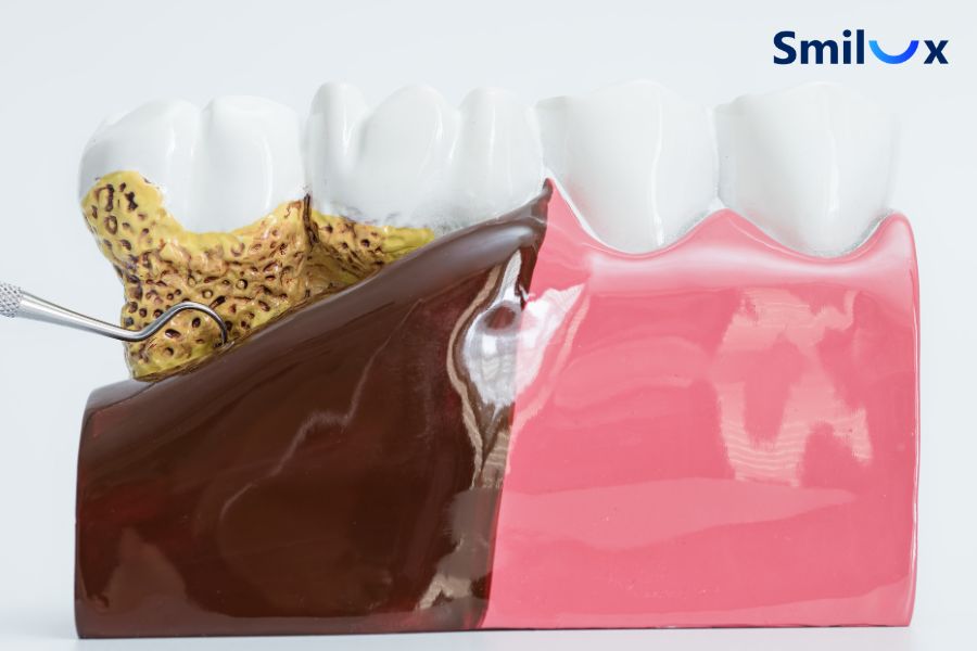 Dáng răng sứ bị hôi miệng do bệnh lý về răng chưa được điều trị triệt để