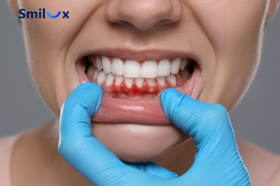 Nếu bị sưng nướu, chảy máu chân răng khách hàng cần kiểm tra lại độ khít của cầu răng