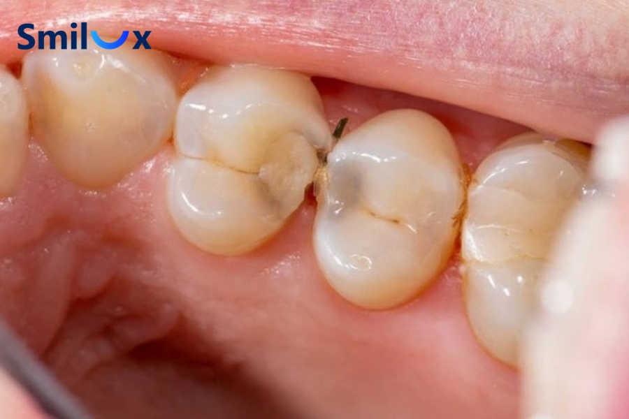 Bọc răng sứ có bị sâu không? Câu trả lời là CÓ.