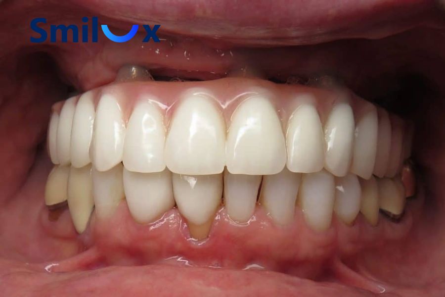 Cầu răng bị cộm, lệch khớp cắn, nhai không đều