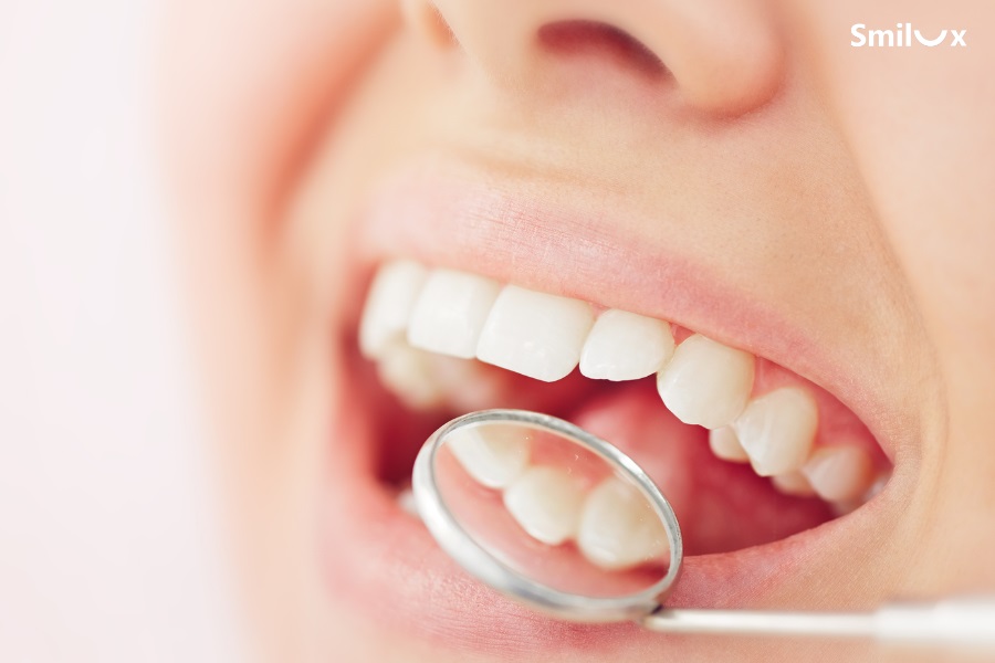 Làm răng sứ Titan có thể bị đen viền nướu