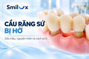 Cầu răng sứ bị hở: Dấu hiệu, nguyên nhân và cách xử lý