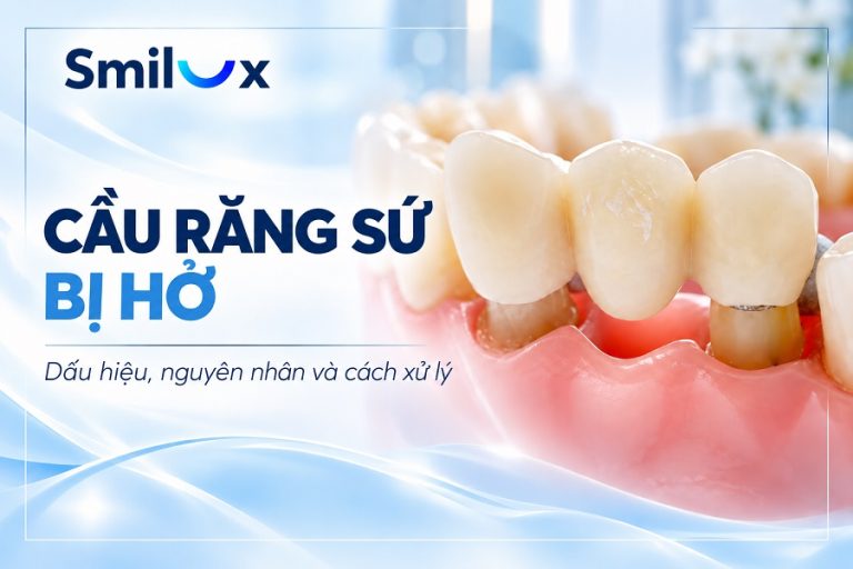 Cầu răng sứ bị hở: Dấu hiệu, nguyên nhân và cách xử lý