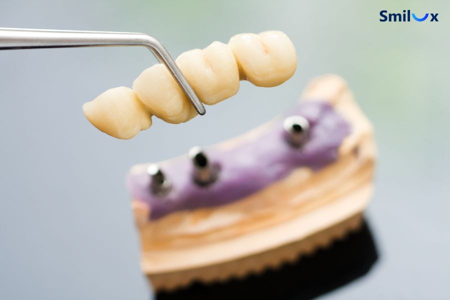 Bắc cầu răng sứ là hình thức phục hình thay thế răng đã mất