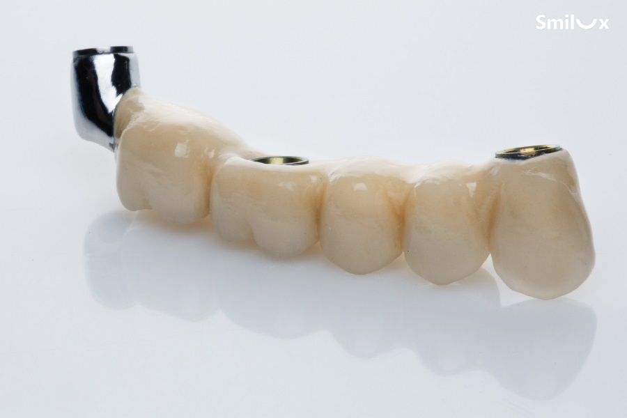 Cầu răng sứ Titan là phương pháp dùng các răng kế cận làm trụ nâng đỡ răng đã mất