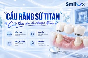 Cầu răng sứ Titan là gì? Cấu tạo, ưu và nhược điểm