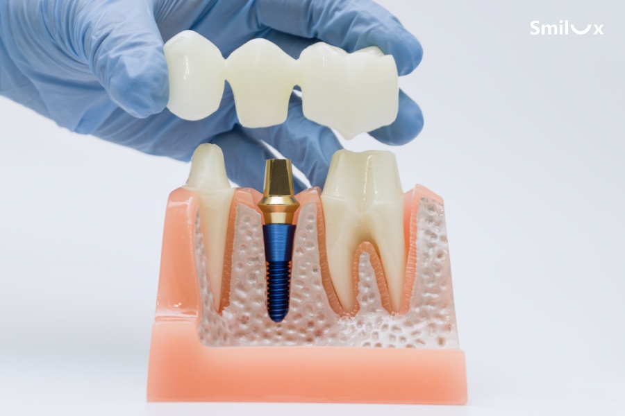 Cầu răng sứ gồm các mão sứ liên kết với nhau khác răng sứ đơn lẻ